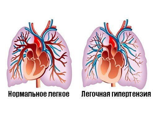 Что такое легочная гипертензия, её симптомы и лечение