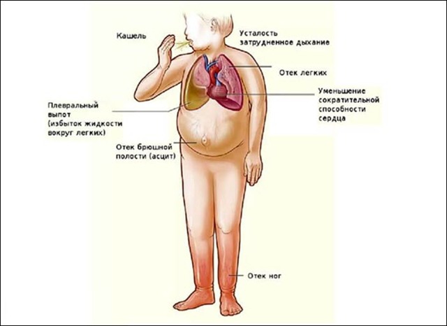 Сердечно легочная недостаточность: симптомы и лечение