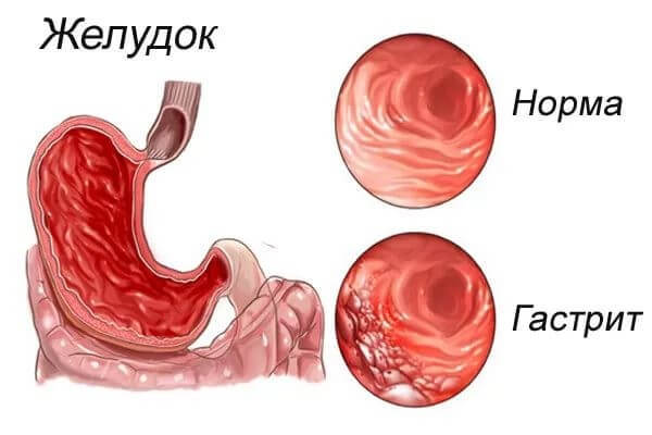 Острый гастрит - причины, признаки, симптомы и лечение