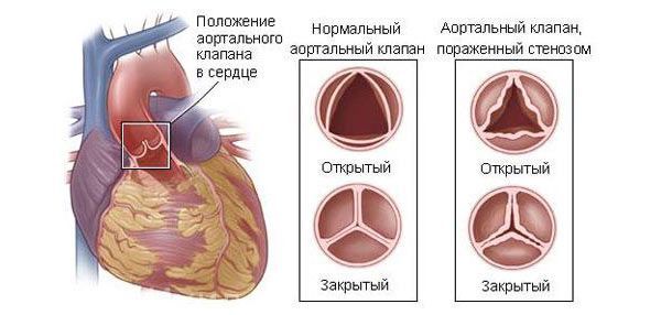 Кальциевые бляшки в сердце - Все про гипертонию