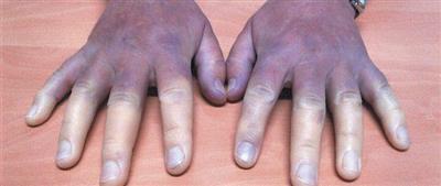 Системная склеродермия - диагностика, лечение, прогноз