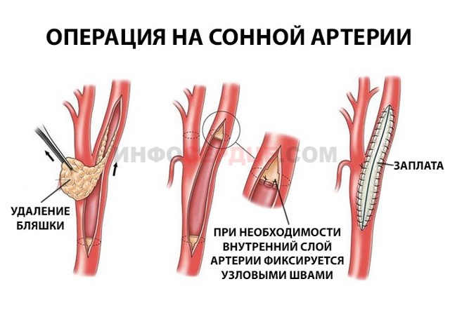 Атеросклеротические стенозы сонных артерий как причина мозгового инсульта - Сибирский медицинский портал