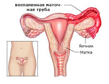 Воспаление придатков: причины, симптомы и лечение воспаления придатков у женщин
