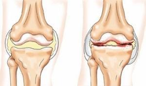 Уколы Дексаметазон: инструкция по применению внутримышечно
