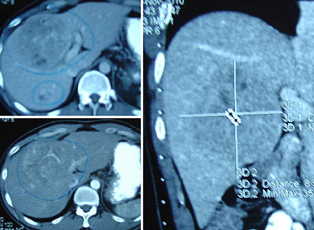 АСТ в крови – какова норма, причины повышения, что означает анализ крови АСТ?