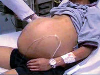 Варикозное расширение вен чем опасно на сайте варикоз