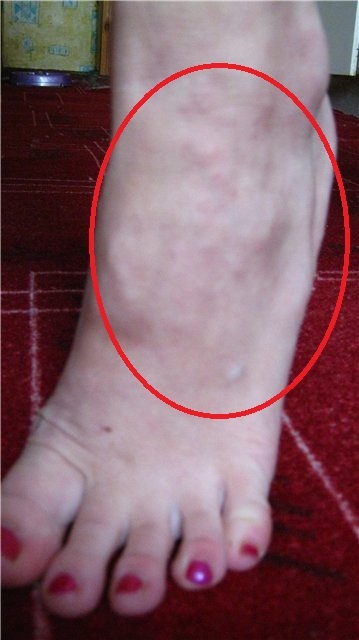 Начальная стадия варикоза на ногах: способы лечения и как распознать (симптомы, диагностика)