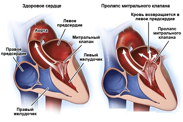 Пролапс митрального клапана (ПМК) 1–3 степени — что это и чем опасен?