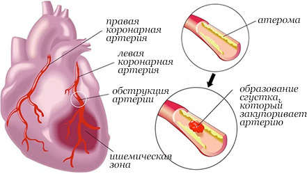 Диета при инфаркте миокарда