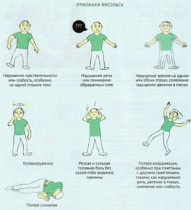 Ишемический инсульт - причины, симптомы, диагностика и лечение