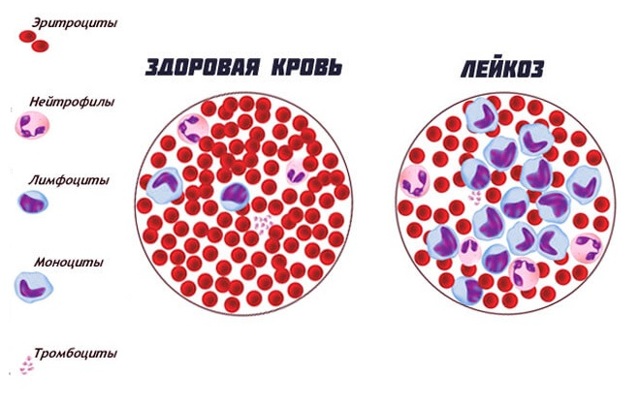 Анизоцитоз в общем анализе крови: что это, виды, причины