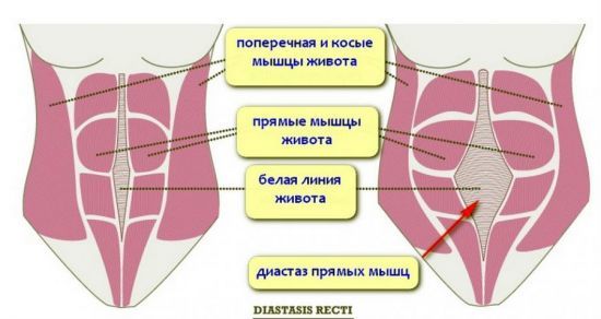 Грыжа белой линии живота - причины, симптомы, диагностика и лечение