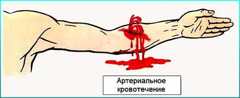 Первая помощь при артериальном кровотечении: алгоритм действий