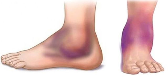 Облитерирующий эндартериит сосудов нижних конечностей - симптомы и лечение