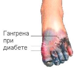 Гангрена при сахарном диабете - причины, признаки и лечение