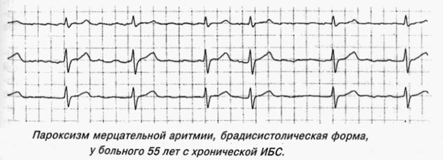 Фибрилляция предсердий экг — Сердце