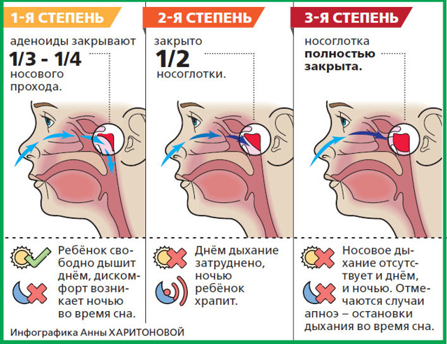 Масло туи при аденоидах для детей - инструкция по применению, отзывы о лечении аденоидов маслом туи