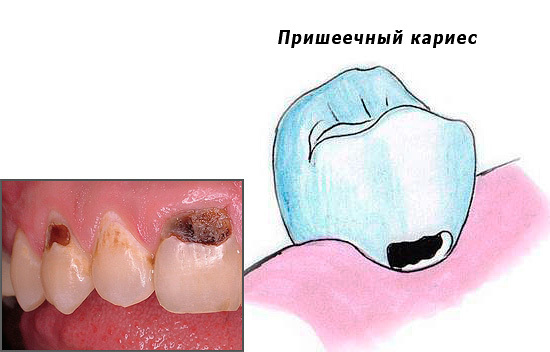 Пришеечный кариес - причины, симптомы, диагностика и лечение