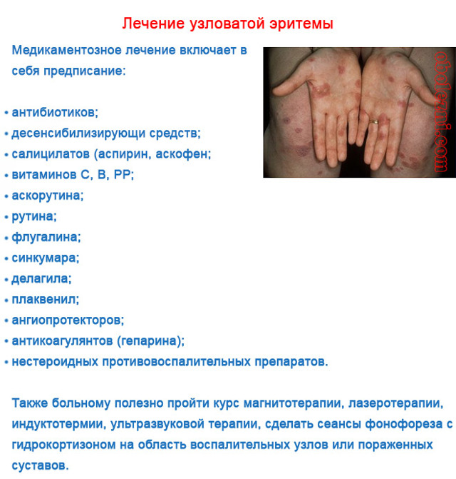 Узловатая эритема: фото, симптомы и лечение