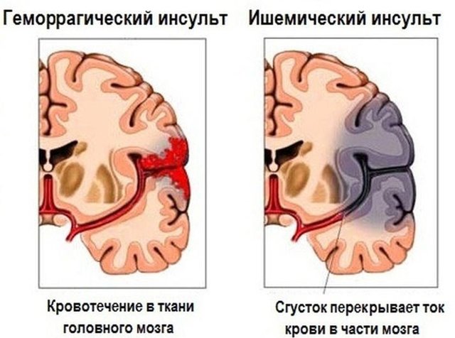Коагулограмма - что это за анализ, как подготовиться, где сдавать, расшифровка результатов у взрослых, детей, беременных
