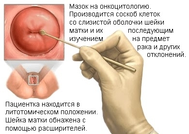 Онкоцитология шейки матки - мазок на онкоцитологию. Цитограмма воспаления с расшифровкой