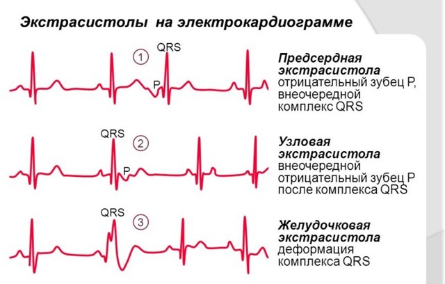 Виды аритмии сердца — типы, разновидности и их главные особенности