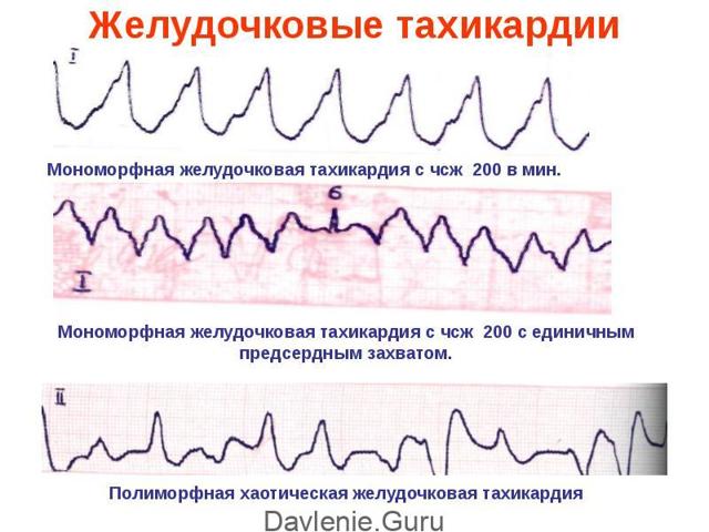 Пульс и давление при простуде