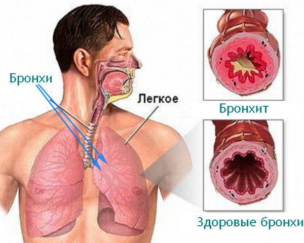 Боль в грудине посередине при вдохе, при нажатии, при движении – причины