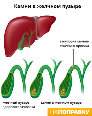 Диагностика и профилактика холецистита