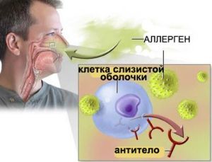 Синусопатия головного мозга