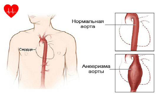 Аневризма сердца - Боль в Сердце