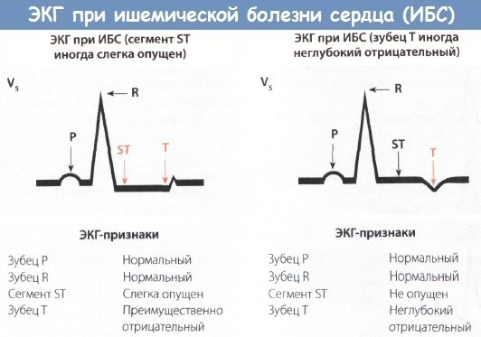 Холтеровское мониторирование экг что это такое — Сердце