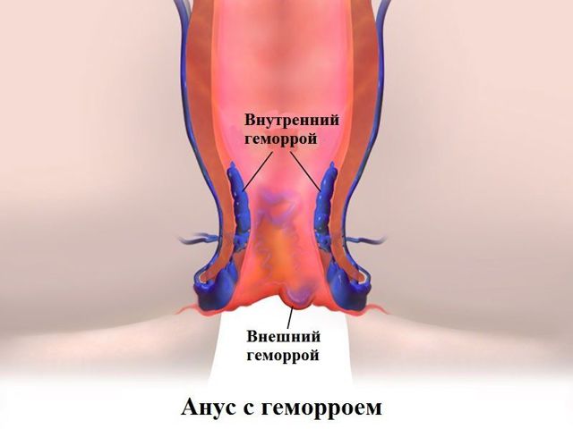 Релиф Ультра – инструкция по применению, цена, отзывы, аналоги