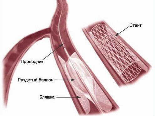 Окклюзия артерий нижних конечностей: что это такое и её лечение