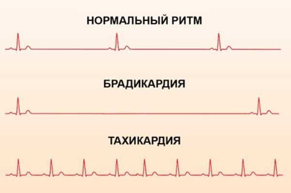 Нормальное сердцебиение в минуту у женщин: норма пульса по возрастам, учащенное сердцебиение
