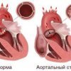 Физические упражнения при стенокардии сердца