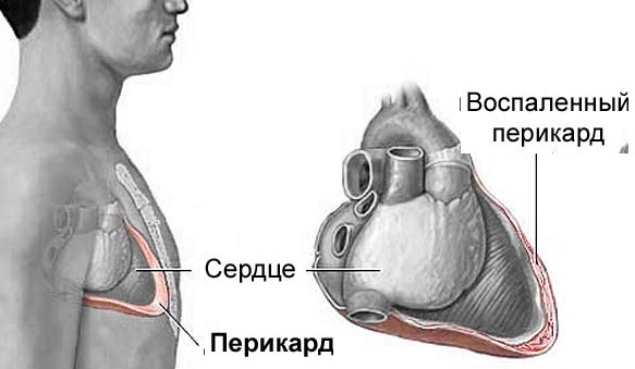 Перикардит: симптомы, лечение