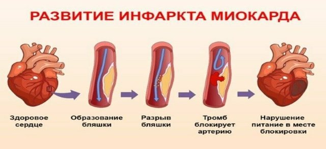 Тропонин в крови: что это, виды (T, I, C), нормы, повышение в анализах, уровень при инфаркте. 3 правила подготовки к проведению тропонинового теста