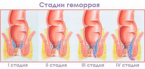 Хронический геморрой – лечение хронического геморроя, симптомы и признаки