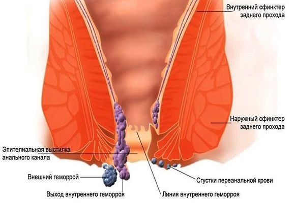 Что делать если геморрой не вправляется — Сайт о геморрое