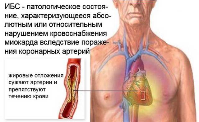 Классификация ИБС по международной классификации заболеваний: диагностика и систематизация, особенности, виды и подвиды заболеваний, факторы риска