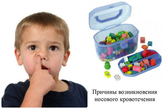 Кровь из носа: причины у взрослых и детей, как остановить кровотечение