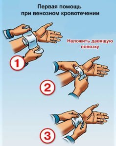 Кровотечения и способы их остановки