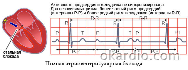Что такое синдром Фредерика: суть, симптомы и лечение патологии. Синдром фредерика: что это, признаки, на экг, лечение