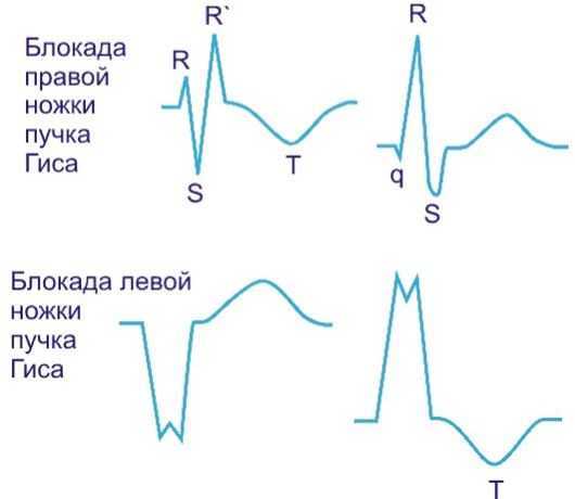 Отклонение эос влево что это такое — Сердце
