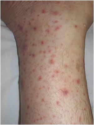 Тромбоцитопения: причины и лечение у взрослых