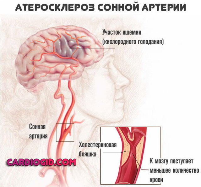 Инфаркт головного мозга - Мое Здоровье