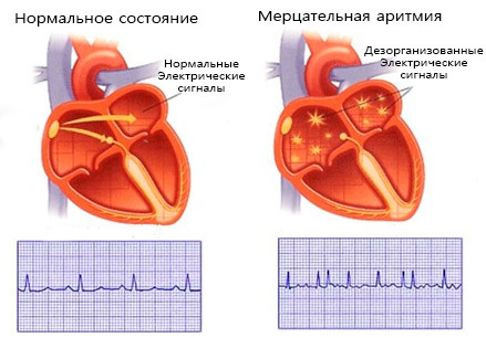 Лечение постоянной формы мерцательной аритмии, фибрилляции и трепетания предсердий.