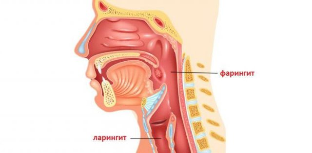 Ларингит и фарингит: симптомы и лечение у взрослых