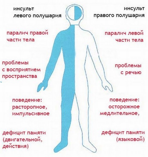 Пульс при геморрагическом инсульте - Инсульт